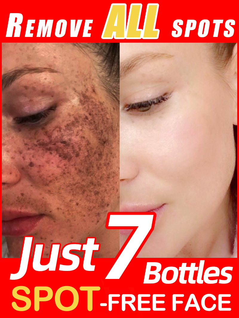 Ultra Luxury Skincare - ลดเลือนฝ้า กระ จุดด่างดำบนใบหน้า